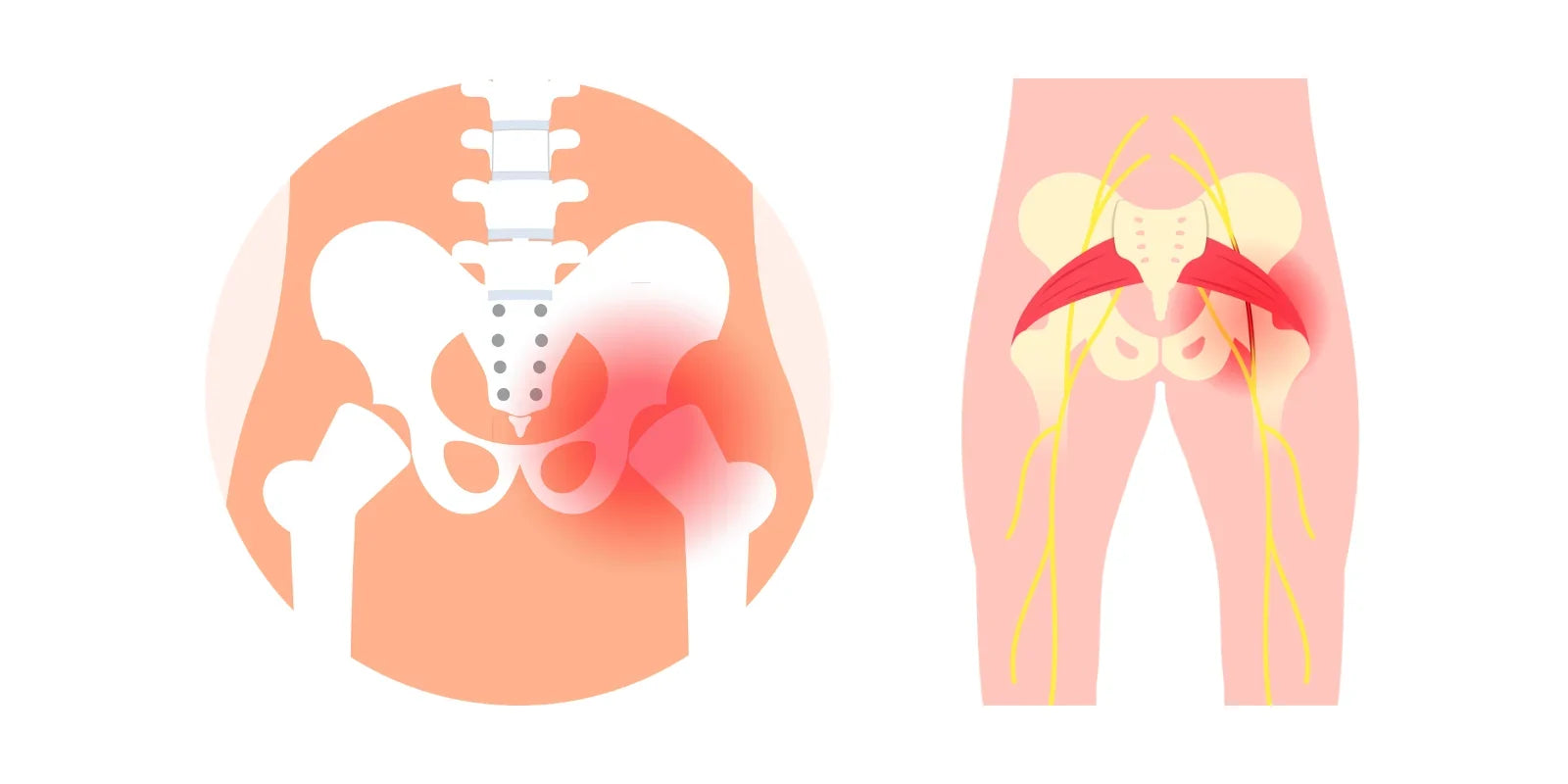 Sciatica and Hip Pain